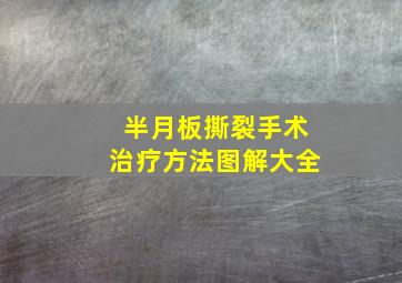 半月板撕裂手术治疗方法图解大全