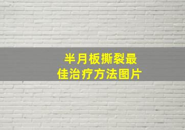 半月板撕裂最佳治疗方法图片