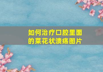 如何治疗口腔里面的菜花状溃疡图片