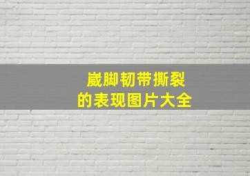 崴脚韧带撕裂的表现图片大全