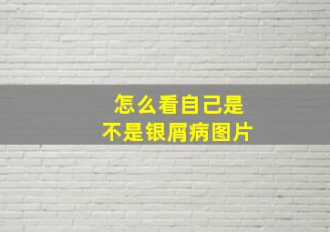 怎么看自己是不是银屑病图片