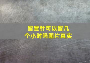 留置针可以留几个小时吗图片真实