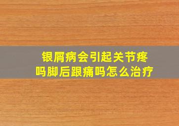 银屑病会引起关节疼吗脚后跟痛吗怎么治疗