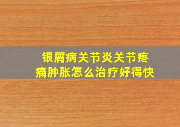 银屑病关节炎关节疼痛肿胀怎么治疗好得快