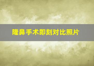 隆鼻手术即刻对比照片